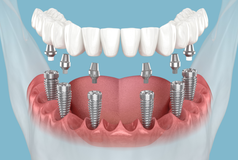 Implant dentar Campina